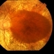 Macula Spared Advanced Retinitis Pigmentosa 11 Macula Spared Advanced Retinitis Pigmentosa 11